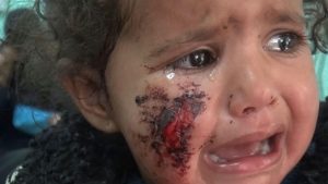 بالصور | إصابة طفلة تبلغ من العمر عامين بغارة لطيران العدوان في نشور بصعدة