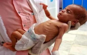 الصحة بغزة :تسجيل حالتين وفاة نتيجة المجاعةخلال الـ24 ساعة الماضية